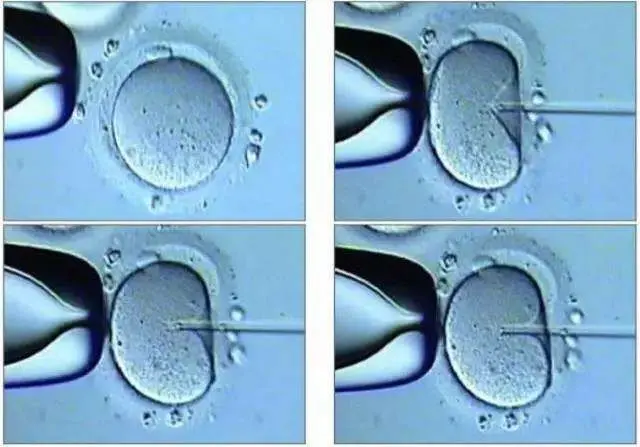 单精子卵胞浆内注射